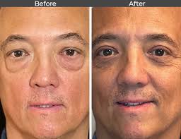 Blepharoplasty