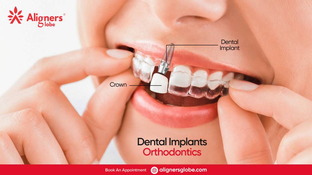 Exceptional Dental Implants